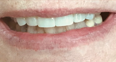 Sage Dental Smile Makeover After 2.1