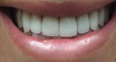 Wall Dentist Smile Transformation After