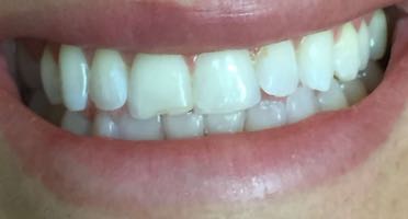 Wall Dentist Smile Transformation Before
