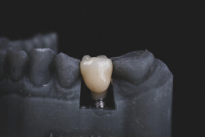 single dental implant wall township