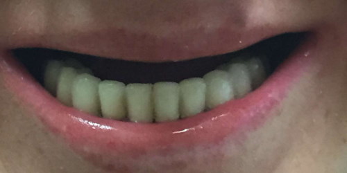 Best Dental Implant Before 2