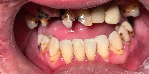 Best Dental Implant Before 3