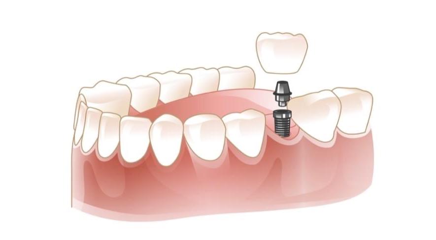 Single Tooth Dental Implants