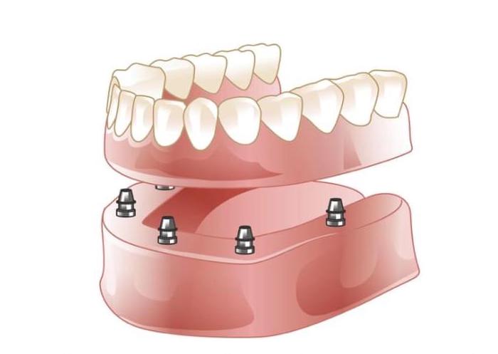 multiple dental implants Wall NJ