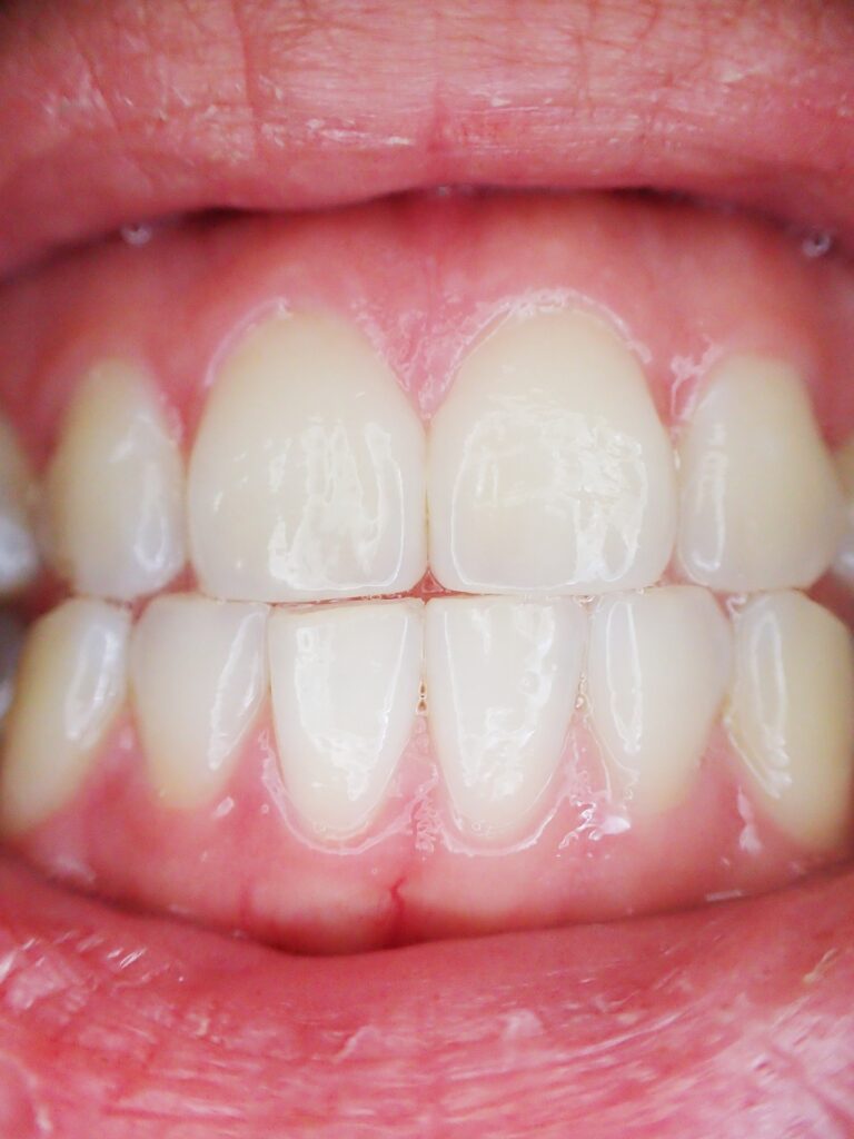 What Do Having White Gums Mean