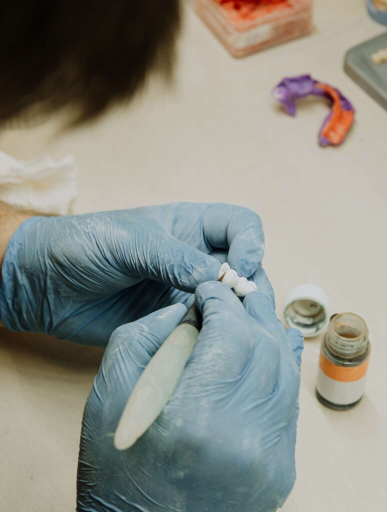 What Are The Benefits of Dental Bridges