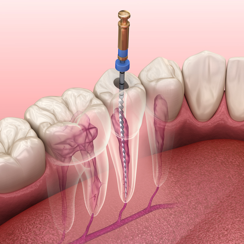 3d model of a root canal