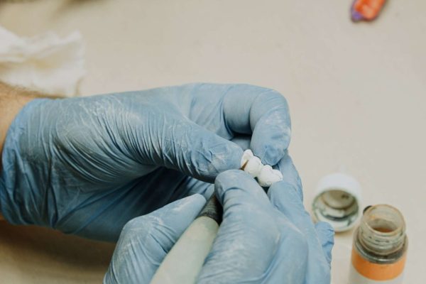 What Are The Benefits of Dental Bridges