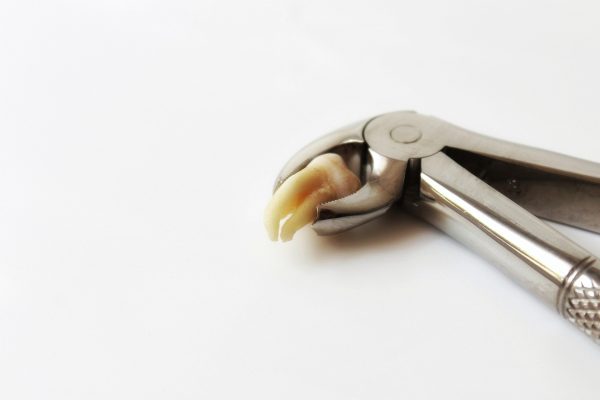 Wisdom teeth removal recovery tips